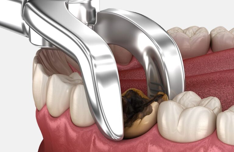tooth-extraction-healing